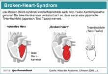 Broken Heart Syndrome